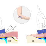 Acupuncture in Medicine publica un artículo sobre EPI® en las epicondilitis